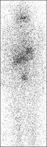 Сканограмма тела пациента с метастазами в легкие после терапии радиоактивным йодом