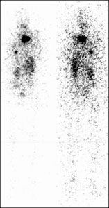 Сканограмма тела пациента с метастазами в легкие до проведения терапии радиоактивным йодом